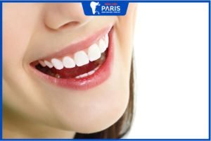 Răng sứ Bio Paris – Giải pháp phục hình răng thẩm mỹ toàn diện