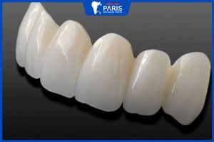 Răng sứ Cercon có tốt không? Được phân chia thành mấy loại?