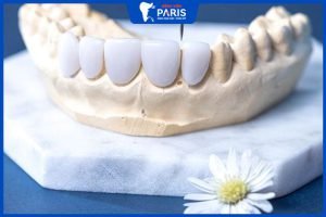 Răng sứ Emax: Phân loại, quy trình và chi phí thực hiện