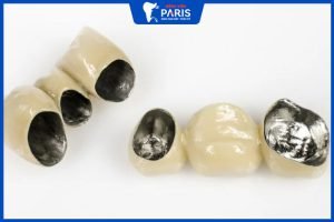 10 điều cần biết về răng sứ kim loại – Đặc điểm nổi bật của răng sứ