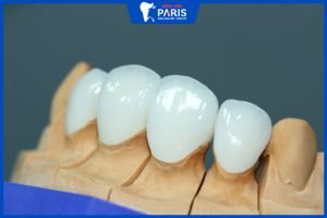 Răng sứ Lava giá bao nhiêu – có bao nhiêu loại- ưu nhược điểm