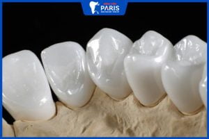 Răng sứ Venus: Ưu điểm nổi bật – Giá bao nhiêu