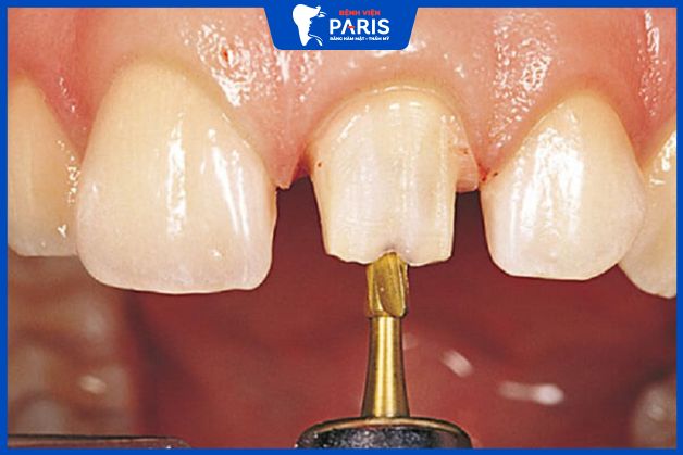 Cùi răng thật được mài bớt trước khi bọc sứ