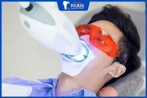 Tẩy trắng răng laser có gây hại không? Hiệu quả trong bao lâu?