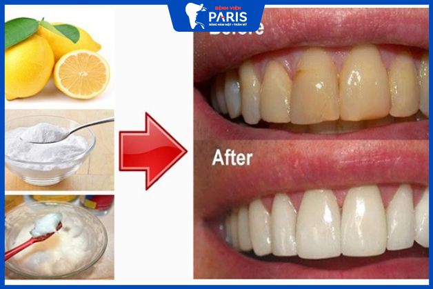 Tẩy trắng răng tại nhà