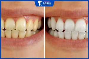 Tẩy trắng răng: Trường hợp nào nên thực hiện? Chi phí bao nhiêu?