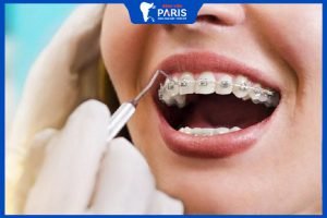 Thời gian niềng răng mất bao lâu mới xong?