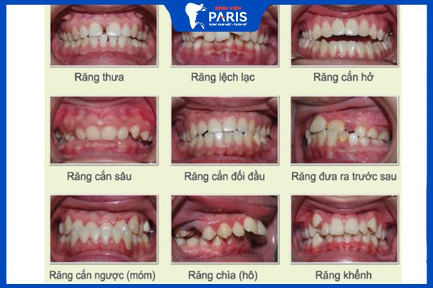 Các trường hợp phải niềng răng