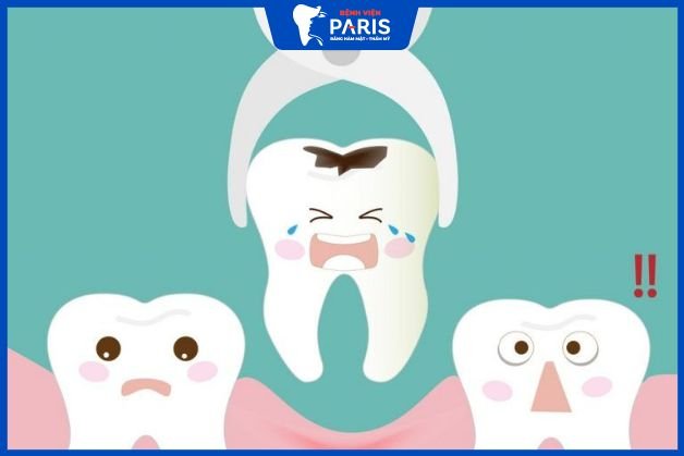 Tổng quan căn bản về nhổ răng
