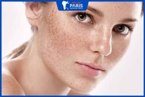 Điều trị nám: 9 Giải pháp hiệu quả và 5 Lưu ý cần biết