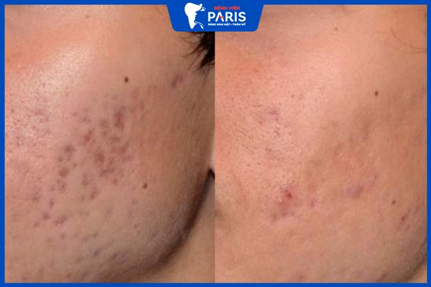 Xóa bỏ đến 90% tình trạng sẹo rỗ, sẹo lõm, sẹo thâm lâu ngày