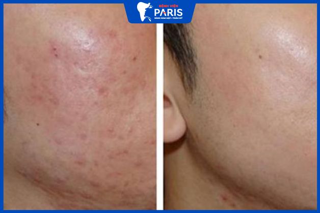 Trẻ hóa da, bổ sung collagen để da săn chắc và sáng mịn hơn