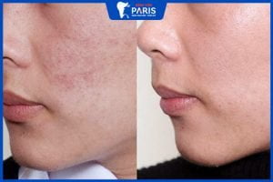 Trị sẹo thâm lâu năm ở mặt không khó với 15 cách đơn giản sau
