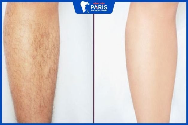 Triệt sạch đến 95% vùng lông mong muốn