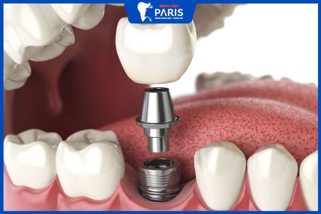 Trồng Implant Korea nên chọn loại nào?