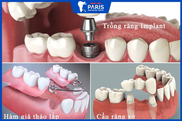 Trồng răng giả là gì?