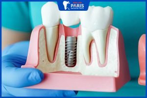 Trồng răng giả – Tất tần tật những điều bạn cần biết trước khi làm