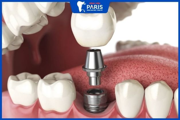 Trồng răng hàm bằng phương pháp cấy ghép implant