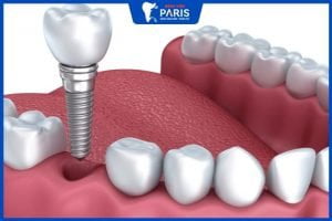 Trồng răng hàm Implant – giải pháp phục hình răng toàn diện nhất