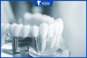 Trồng răng Implant – giải pháp toàn diện cho người bị mất răng lâu năm