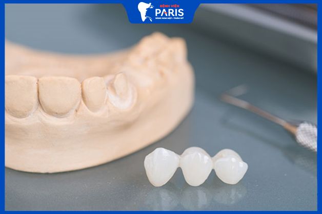 Mão sứ trồng răng Implant bao nhiêu tiền một cái tại Nha khoa Paris?