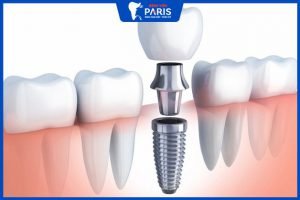 Trồng răng Implant bao nhiêu tiền? Địa chỉ tin cậy dành cho bạn