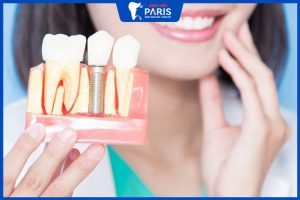 Trồng răng Implant bệnh viện răng hàm mặt – Những điều cần hiểu rõ