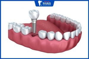 Trồng răng Implant được bao lâu? – 3 tips kéo dài tuổi thọ răng