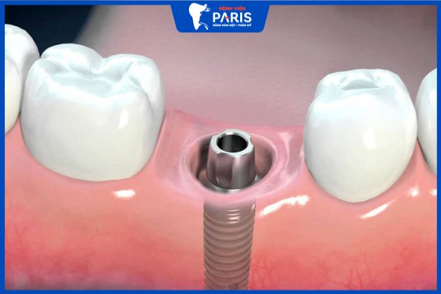 Trồng răng Implant mất bao nhiêu thời gian?