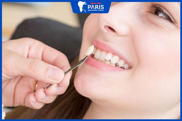 Trồng răng khểnh bằng vật liệu composite