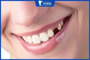 Trồng răng nanh – có đau không- Giá 1 chiếc răng bao nhiêu