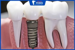 Trụ Implant ETK: Xuất xứ, lợi ích và chi phí cấy ghép