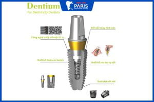 Trụ Implant Dentium – Tính năng vượt trội- giá bao nhiêu