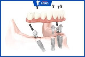 Trồng răng Implant All On giá bao nhiêu – công nghệ tái sinh cả hàm răng