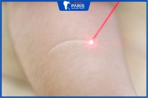 Xóa sẹo bằng laser: Có tốt không? Bao nhiêu tiền?
