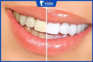 5 Cách làm trắng răng trong 1 tuần đơn giản, hiệu quả bất ngờ