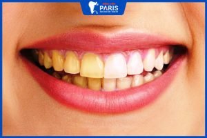 10 Cách trị răng bị ố vàng hiệu quả tại nhà Nhanh, Hiệu quả nhất