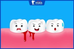 Chảy máu chân răng không ngừng: 3 Cách xử lý và phòng ngừa hiệu quả