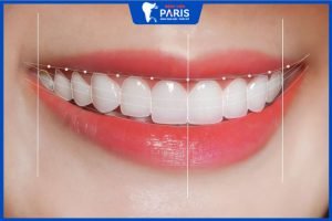 Cung răng chuẩn: 6 Yếu tố tạo nên cung răng chuẩn