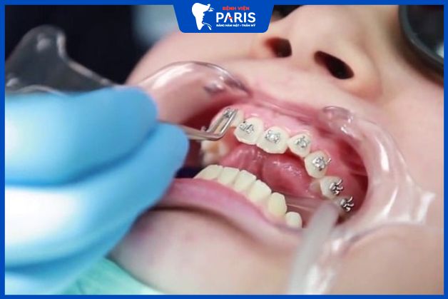 Đang có răng khểnh duyên thì có nên niềng không?