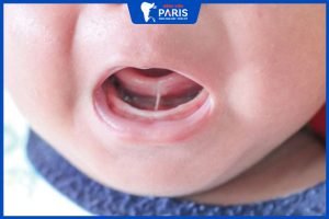Dính phanh lưỡi ở trẻ em: 2 Cấp độ cần biết khi bé bị dính phanh lưỡi