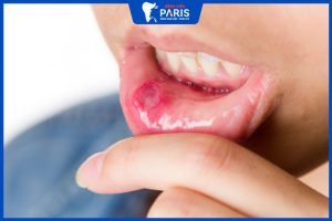 Lở miệng làm sao hết? Nguyên nhân, những cách điều trị đơn giản