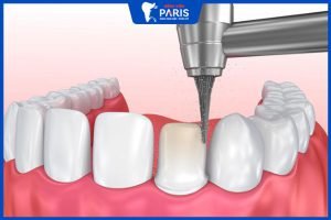 Mài răng có ảnh hưởng gì không? Trường hợp nào cần mài răng?