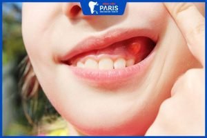 Mọc mụn ở nướu răng nguyên nhân do đâu? Cần phải làm gì?