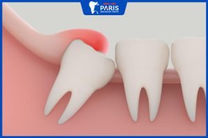 Mọc răng khôn bị sốt không? Cần làm gì để nhanh thuyên giảm?
