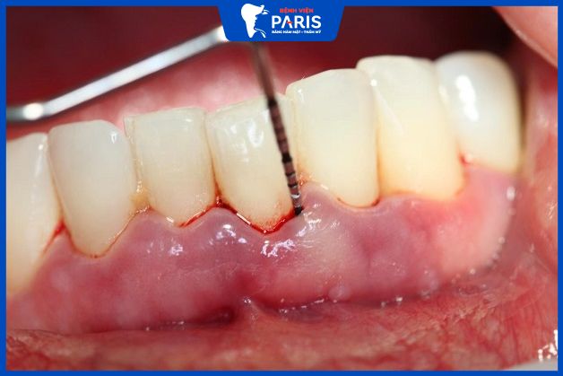 Nguyên nhân gây ra tình trạng lợi bị sưng mủ