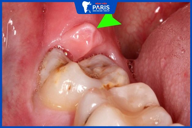 Nhận biết răng khôn bị viêm lợi trùm như thế nào?