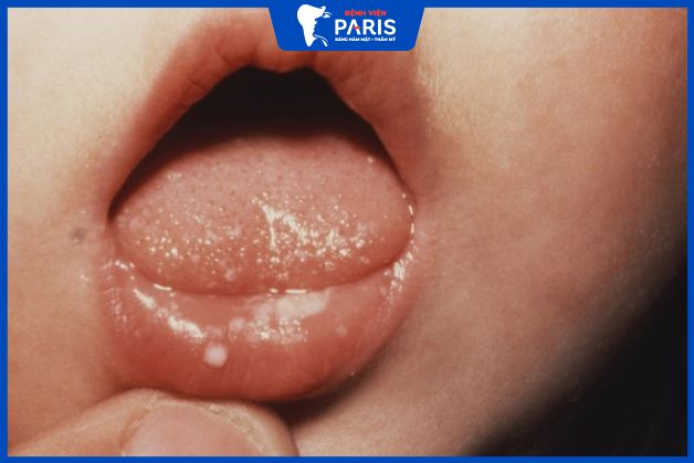 Trẻ em bị nhiệt miệng có gây sốt không?