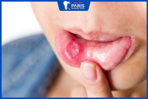 Giải đáp thắc mắc: Nhiệt miệng có gây sốt không- 5 cách chữa hiệu quả