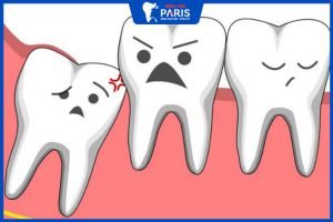Nhổ răng khôn bao lâu hết đau? – 4 tips giảm đau nhanh chóng